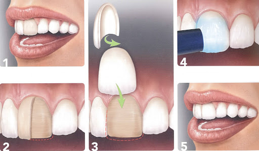 faccette dentali bologna