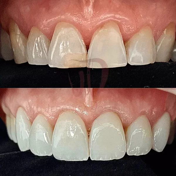 Faccette dentali Veronica Dominici Studio Dentistico Bologna Dentista