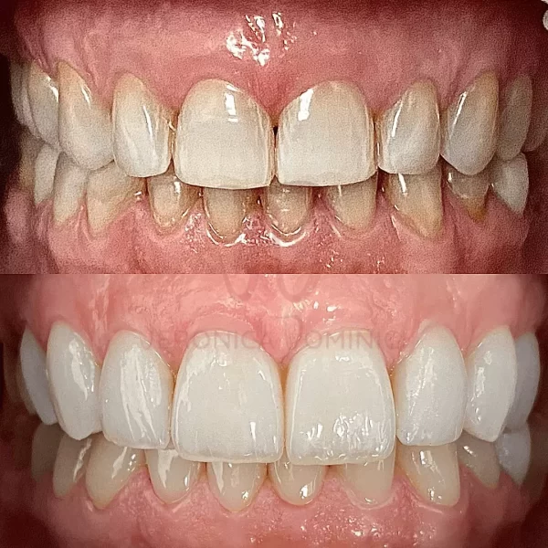 Faccette dentali Veronica Dominici Studio Dentistico Bologna Dentista