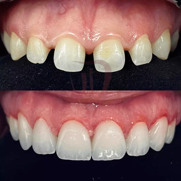 Faccette dentali Veronica Dominici Studio Dentistico Bologna Dentista