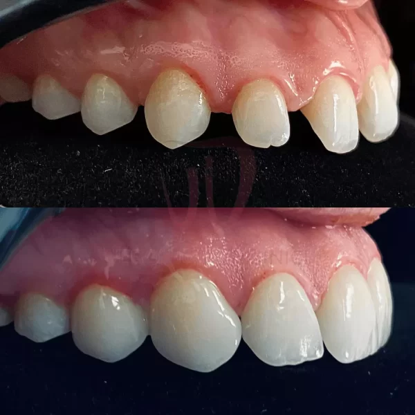 Faccette dentali Veronica Dominici Studio Dentistico Bologna Dentista