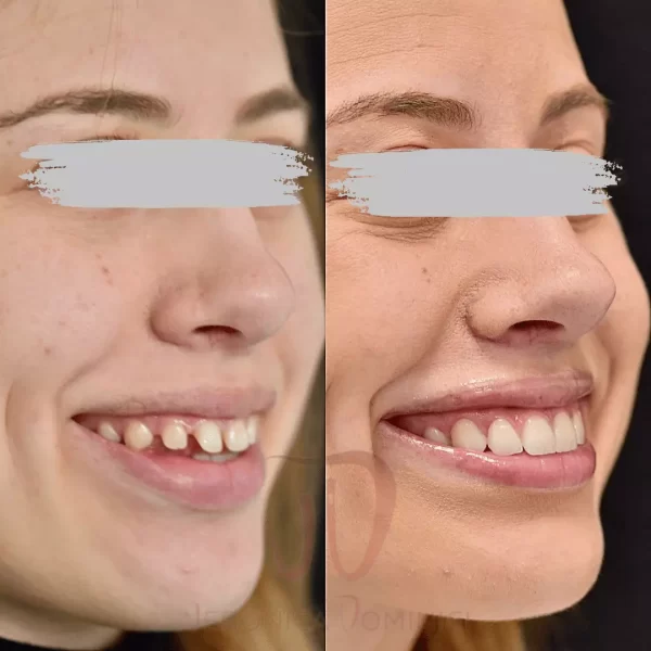 Faccette dentali Veronica Dominici Studio Dentistico Bologna Dentista